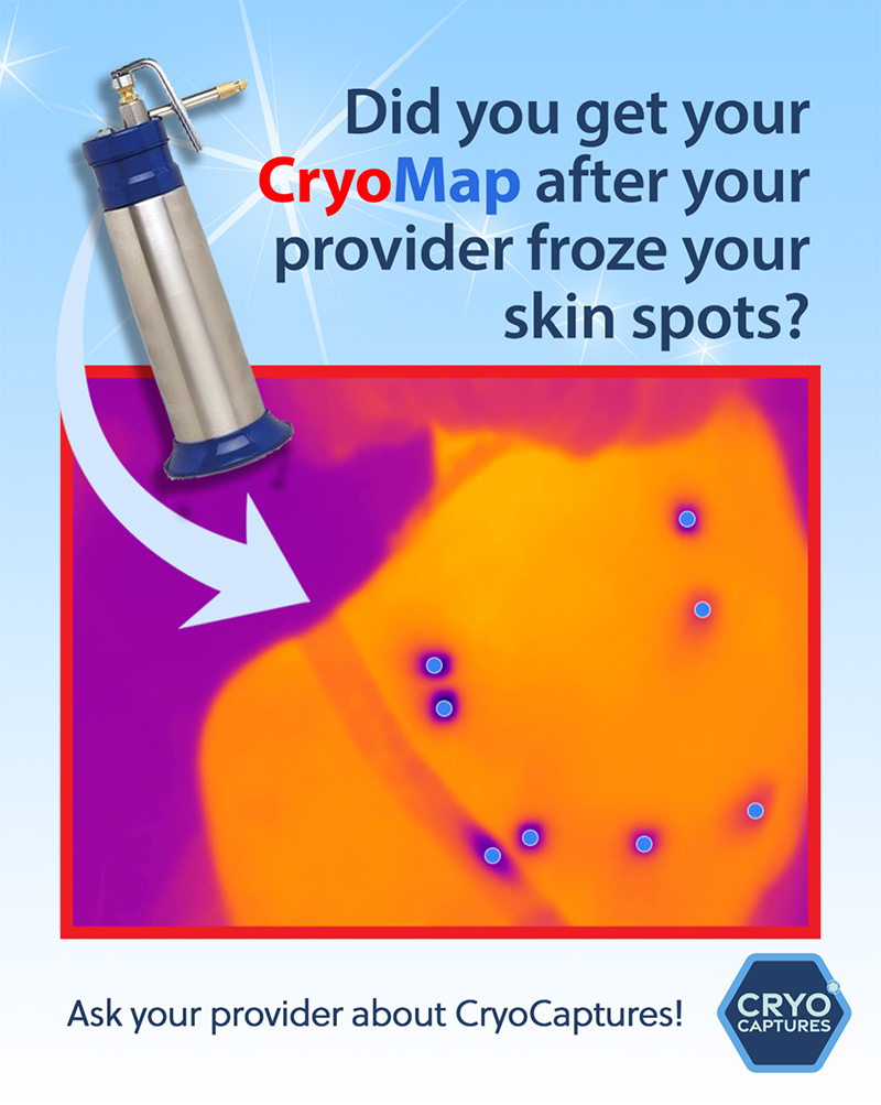 Did you get your CryoMap after your provider froze your skin spots?